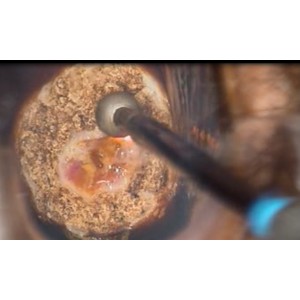 Máy cắt đốt (cắt LEEP) cổ tử cung chuyên dụng Deltronix